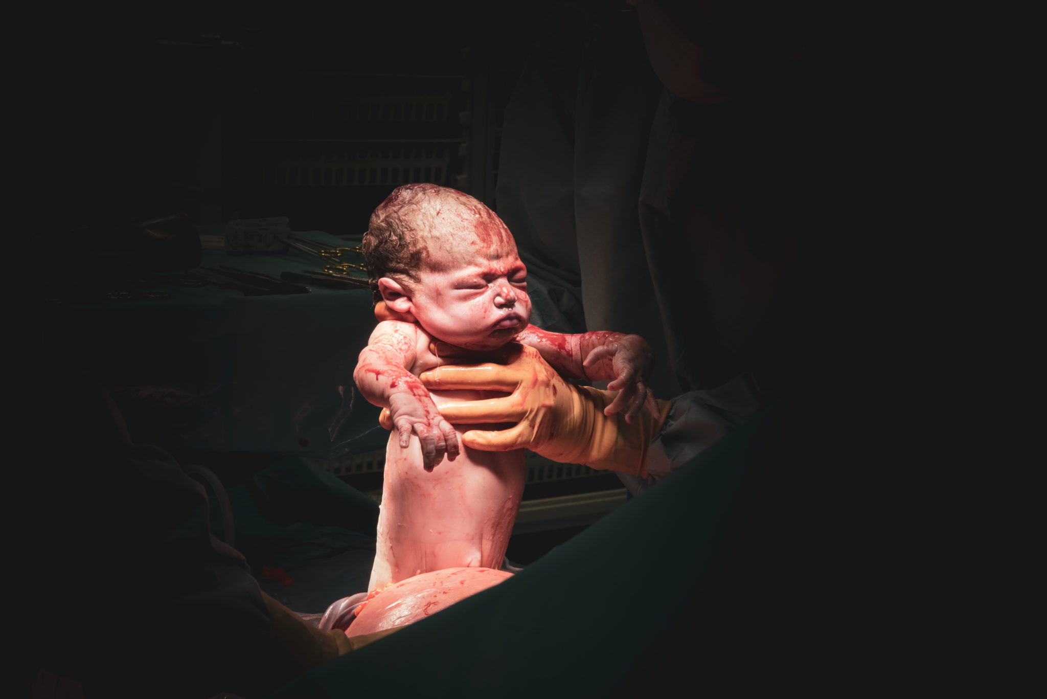 Geboorteverhaal Renate - Doula - Geboortefotograaf - Bracke Cynthia - DoulaGraaf - speodkeizersnede - keizersnede